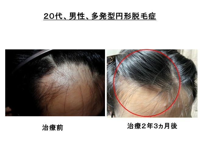 円形脱毛症　病院